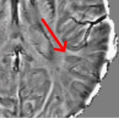 Animation of a paramagnetic rim lesion