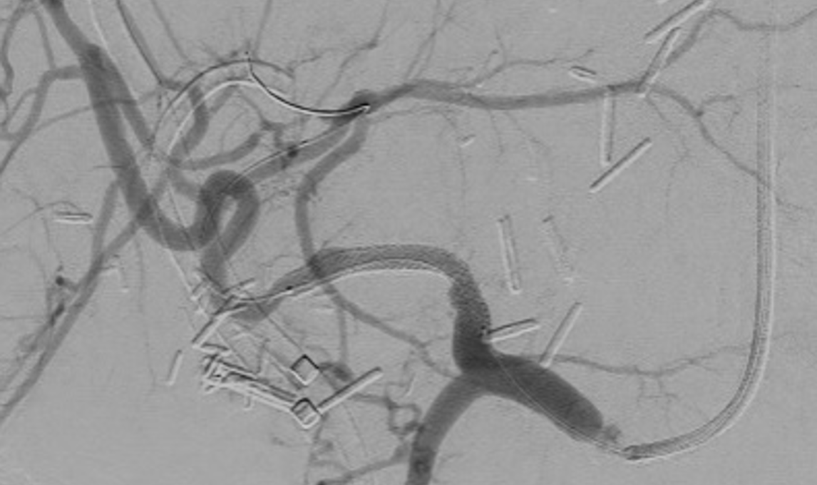 DEB in Distal Transplant Hepatic Artery